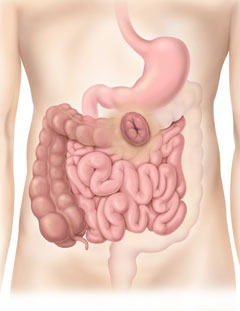 Colostomía transversal