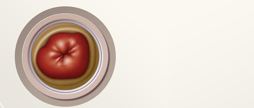 um close-up de um estoma