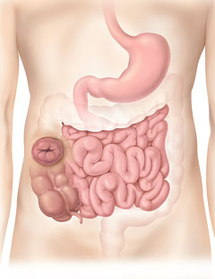 Ascending Colostomy