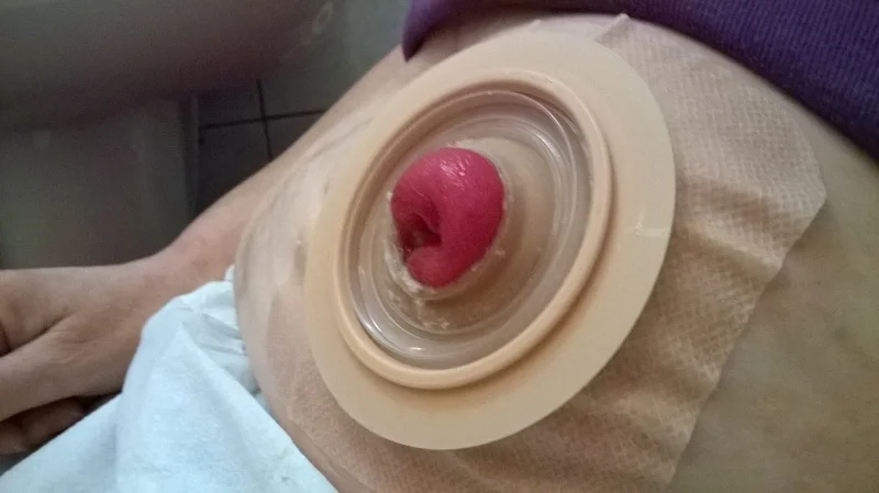 Stomia wypadająca zaopatrzona sprzętem dwuczęściowym